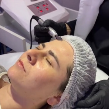 Безін"єкційна мезотерапія - електропорація -  #електропорація #мезотерапія #мезотерапия