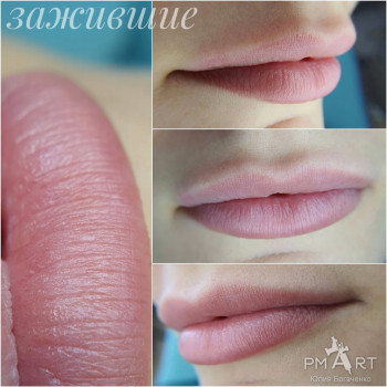 Зажившие губы помле первой процедуры