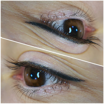 Зажившие стрелки