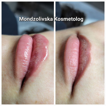 Збільшення губ 1.0 ml
