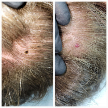 Видалення ангіоми на голові