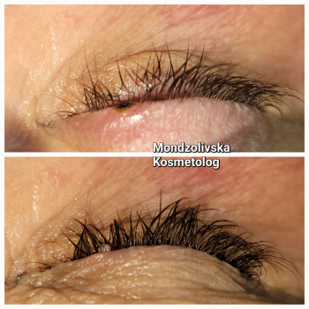 Видалення папілом на оці