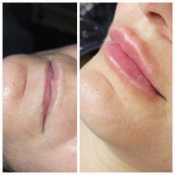 Корекція тонких губ