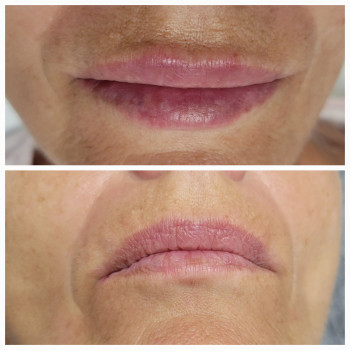 Корекція губ в 60+