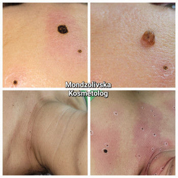 Видалення новоутворень