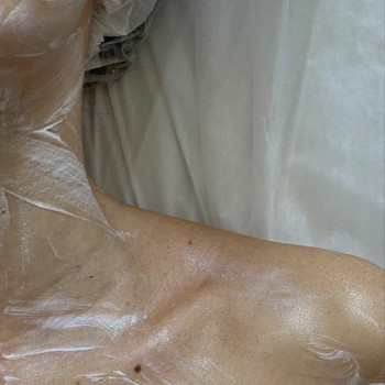 Знеболення анестезуючим кремом