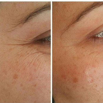 Мезотерапія обличчя
                    Косметолог-инъекционист Марьяна Фастов