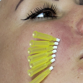 Армування носогубної складки