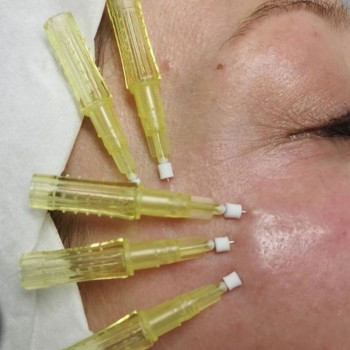 Укріплення вилиці