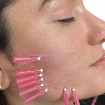 Тредліфтинг нитками, біоармування
                    Косметолог-ін'єкціоніст Марьяна Фастів