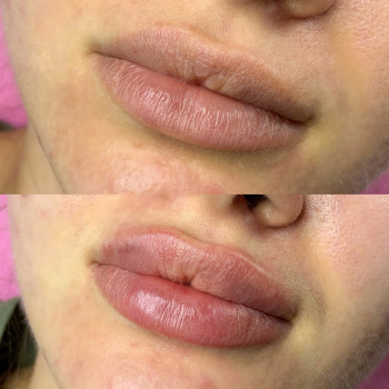 Препарат: Juvederm Ultra Smile 0,55ml