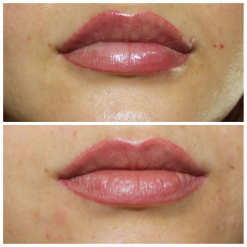 Контурна пластика губ