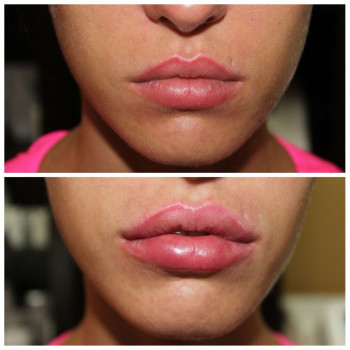 Контурна пластика губ
