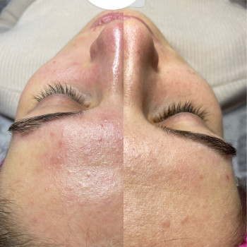 Чистка+ пілінг