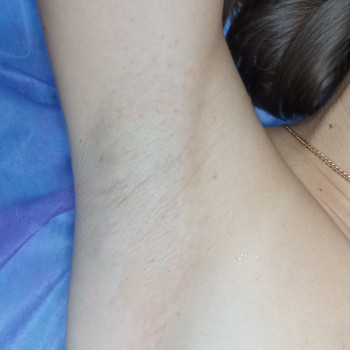 Стан шкіри зразу після процедури