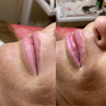 Контурна пластика губ
                    Косметолог Людмила Киев