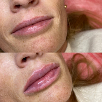 Контурна пластика губ
                    Косметолог Людмила Киев