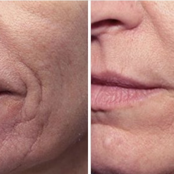 Микроигольчатый RF лифтинг
                    СПА-салон Aura Spa Кривий Ріг