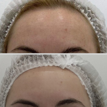 Микроигольчатый RF лифтинг
                    СПА-салон Aura Spa Кривий Ріг