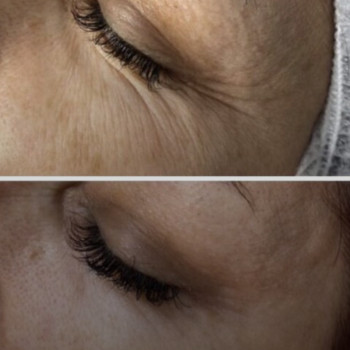 Микроигольчатый RF лифтинг
                    СПА-салон Aura Spa Кривий Ріг