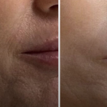 Микроигольчатый RF лифтинг
                    СПА-салон Aura Spa Кривий Ріг