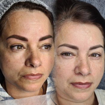 Лазерный карбоновый пилинг Борщаговка Киев
                    Майстер перманентного макіяжу Светлана Київ