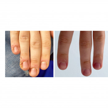 Лікування бородавок методом радіохвилі