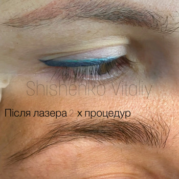 татуаж бровей, лазерная эпиляция