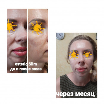  
Коррекция носогубной складки
До.после и через месяц