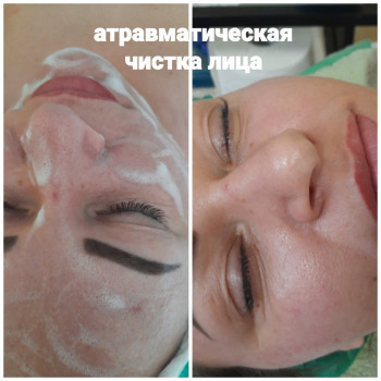  #атравматичначисткаодеса
Комбинированная чистка во время и после чистки