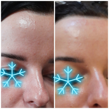  
До и после чистки(гладкая кожа.закрытые поры)