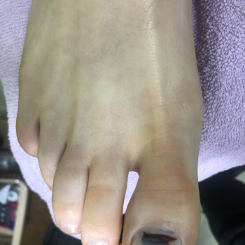 Робота з врослим нігтем
                    Подолог Оксана Каменец-Подольский