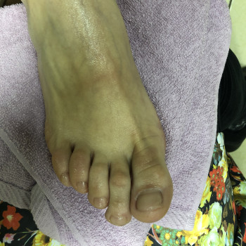 Робота з врослим нігтем
                    Подолог Оксана Каменец-Подольский