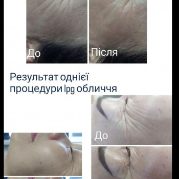 LPG Body Aesthetics, Бровари Фото - 17