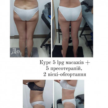 LPG Body Aesthetics, Бровари Фото - 26