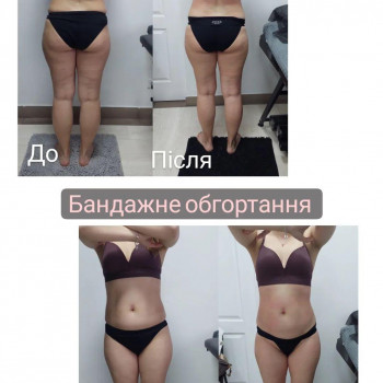 LPG Body Aesthetics, Бровари Фото - 30