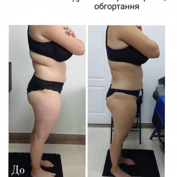 LPG Body Aesthetics, Бровари Фото - 35