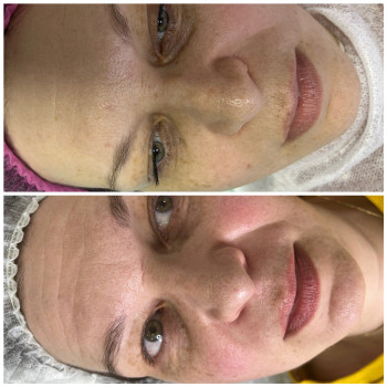 Курс пілінга PRX -t33