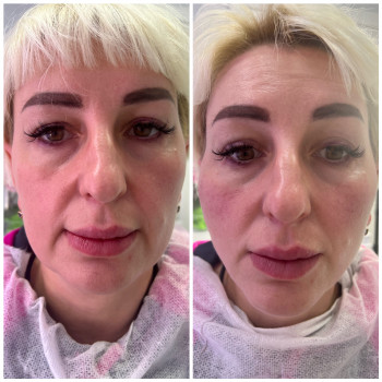 Коркуія середньоі третини обиччя