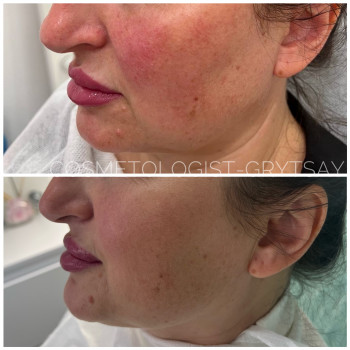 Ліполіз обличчя
                    Косметолог-ін'єкціоніст Наталья Дніпро