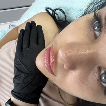 Корекці підборіддя #