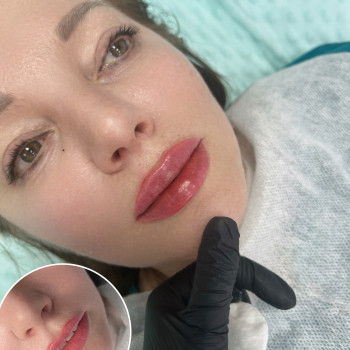 Збільшення губ
                    Косметолог-инъекционист Наталья Днепр