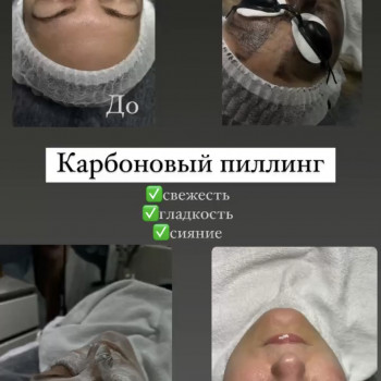 Карбоновий пілінг