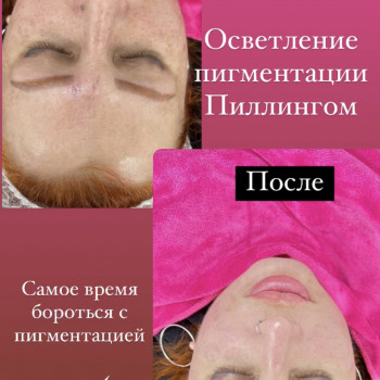 Освітлюючий пілінг