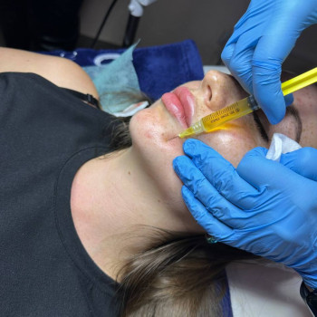 Плазмотерапія
                    Косметолог Людмила Бровари