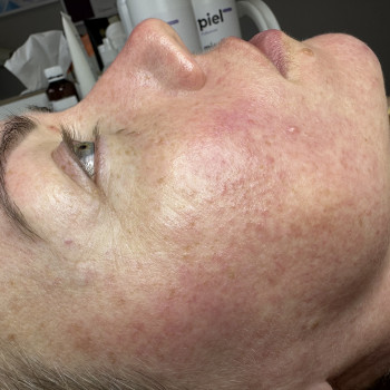 Після 1 процедури