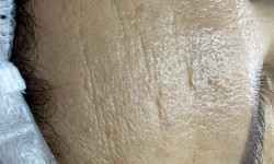 Ферментотерапія Косметолог Людмила Бровари