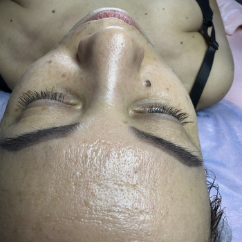 После ( 1 процедура), фото - косметолог Людмила Ткачук