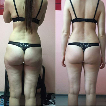 Результат курсу антицелюлітного масажу