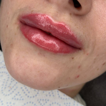 Увеличение уст, фото - Салон красоты Cocoon